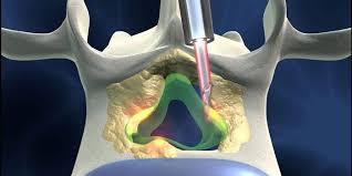 Endoscopic spine surgery